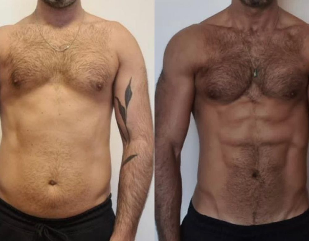 ANTES E DEPOIS ALE ANTES E DEPOIS ALE