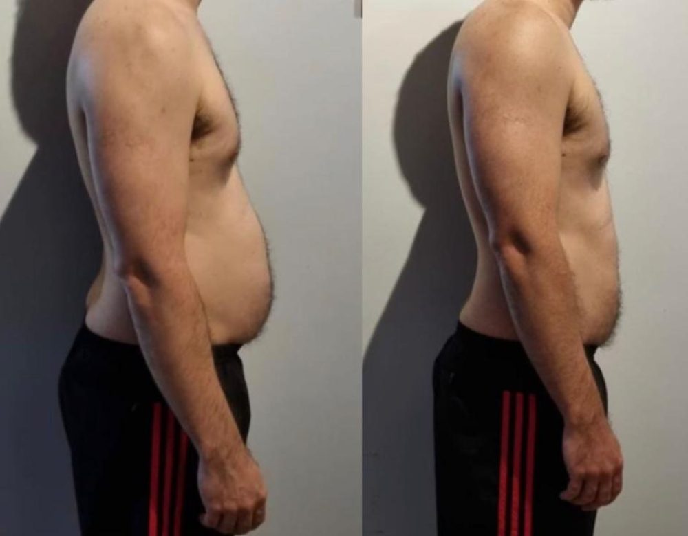Antes e depos flavio Antes e depos flavio